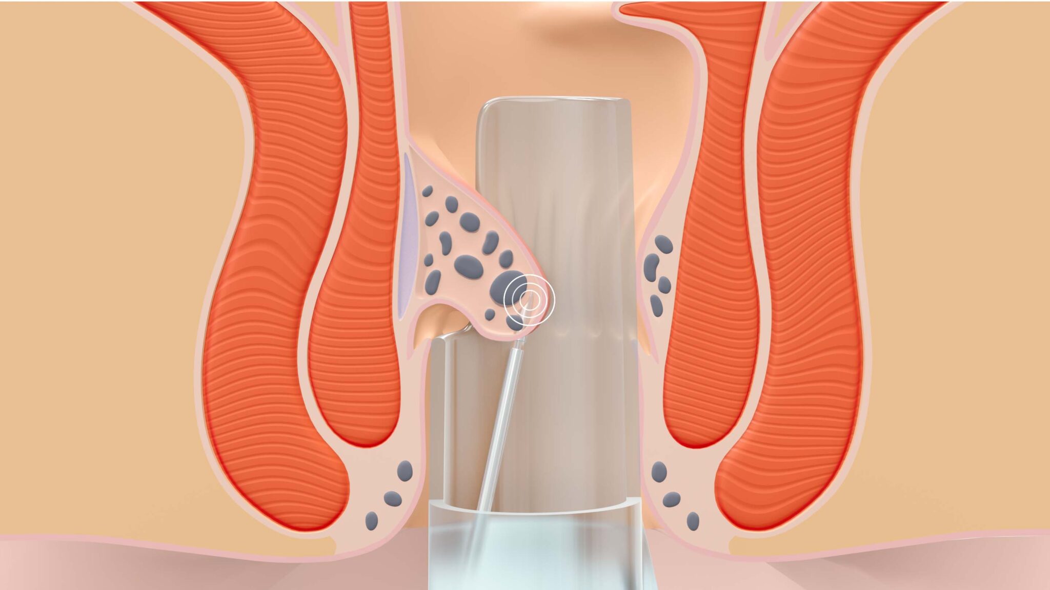 The Rafaelo Procedure