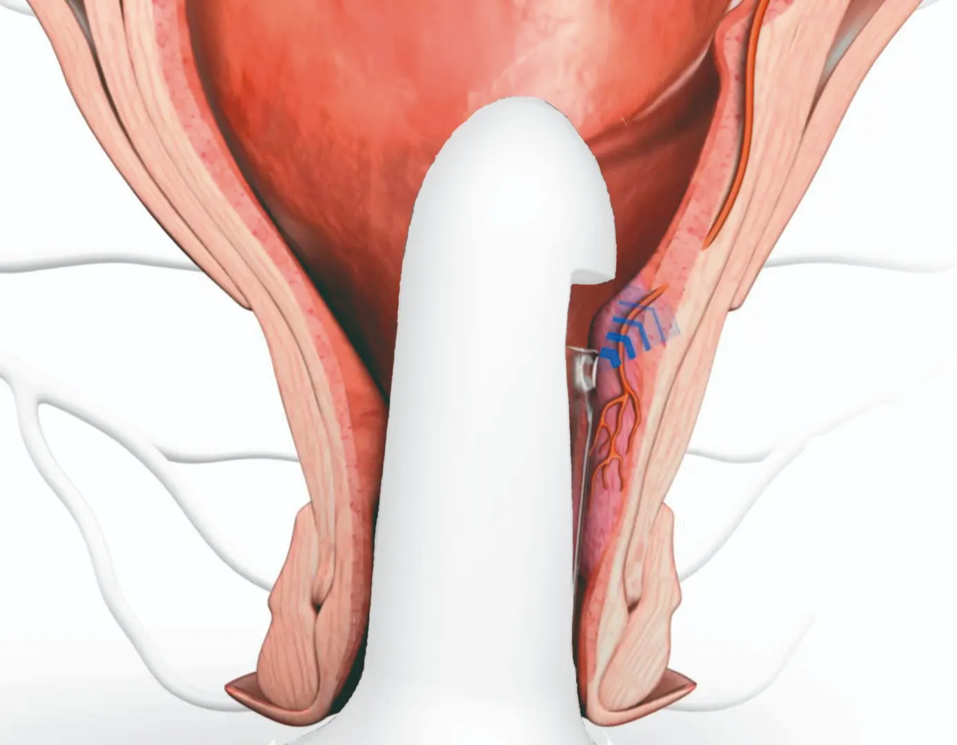 The HALO Procedure