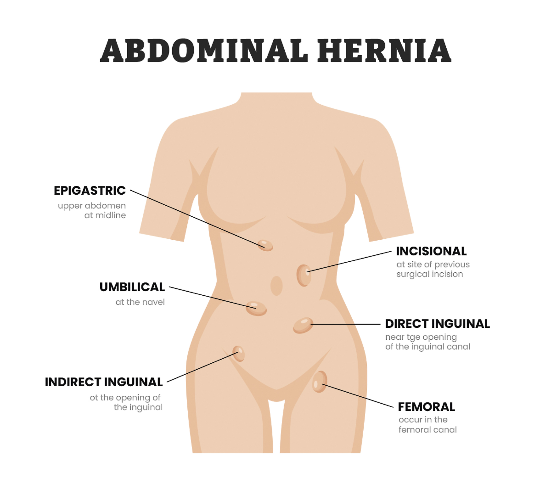 Abdominal Hernia types