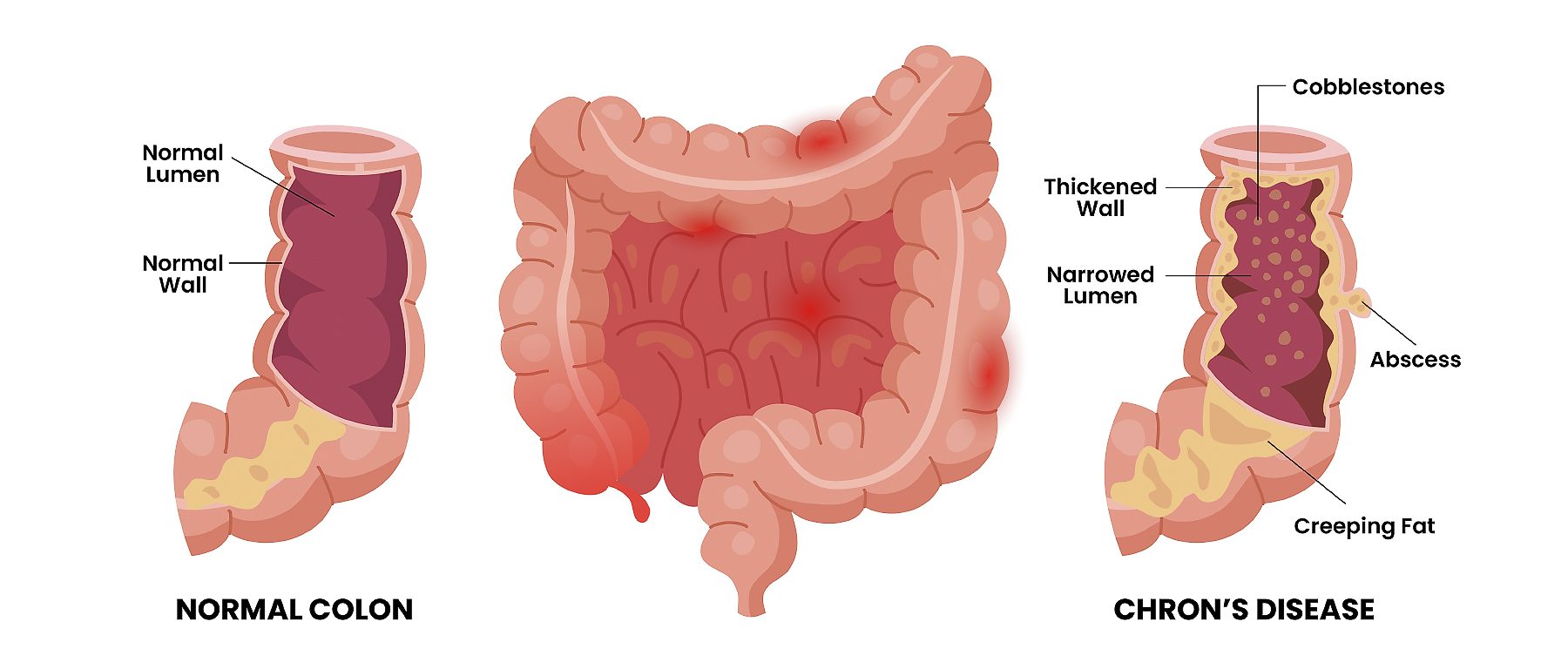 Crohn's disease with colon large intestine cross section view
