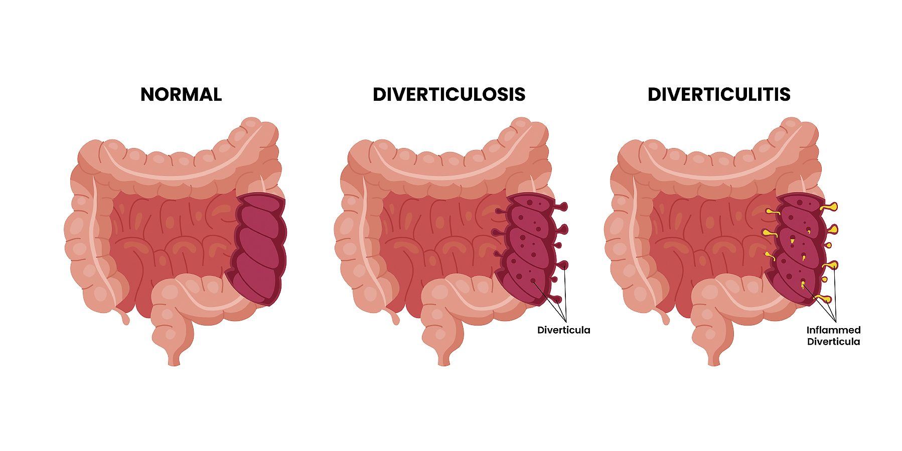 Different types of Bowel colon cancer, labeled healthy colon, diverticulosis, diverticulitis with colonoscopy. Diverticula, rectum, sigmoid colon. Colorectal colon. Medical illustration vector.