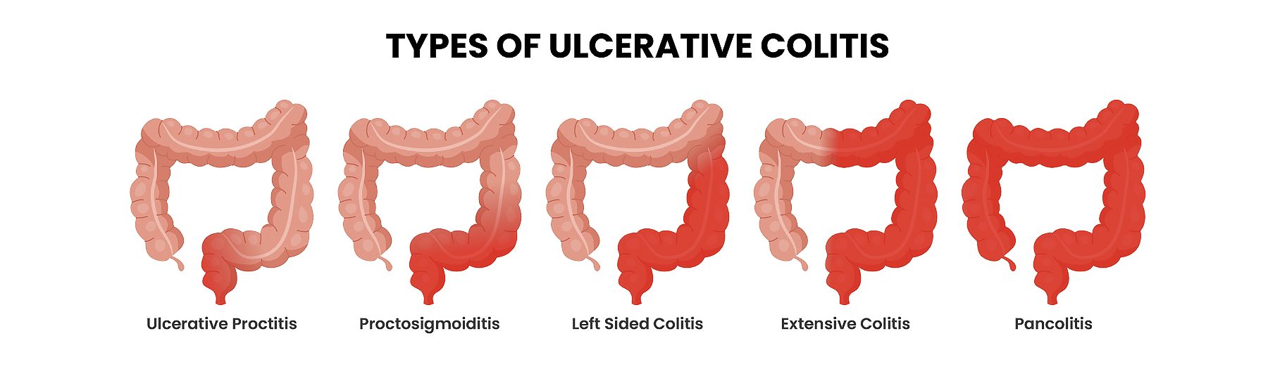 Different types of ulcerative colitis types. Labeled ulcerative