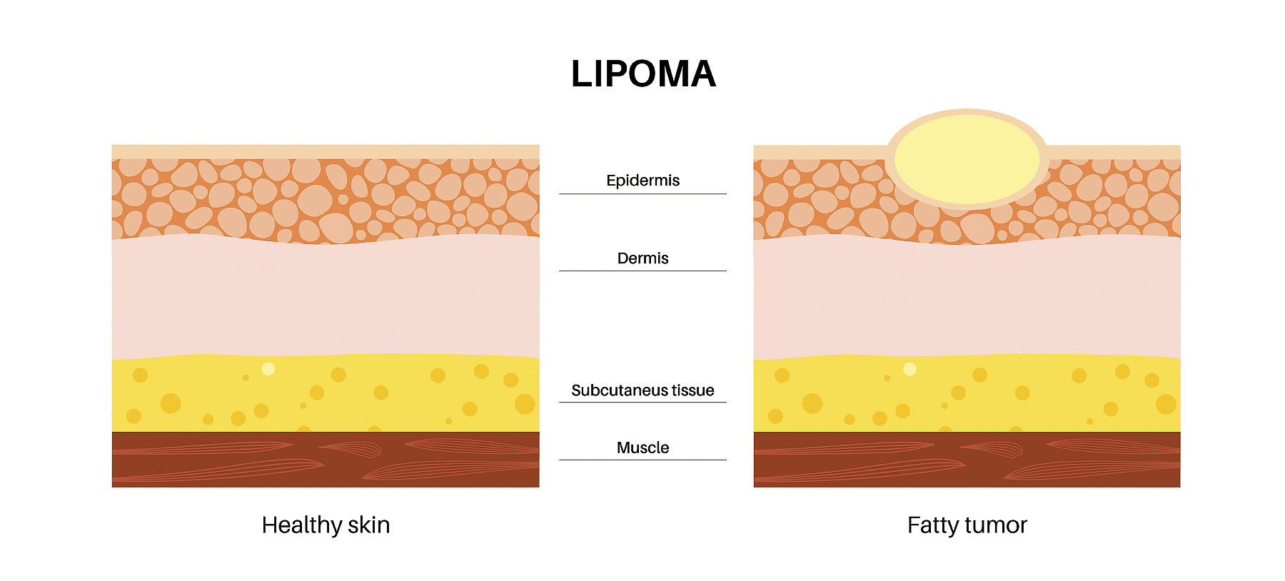 Lipoma fatty tumor medical poster. Not cancer, benign tumor under skin, fat lump in human body. Skin layers structure epidermis, dermis and hypodermis and muscle medical flat vector illustration