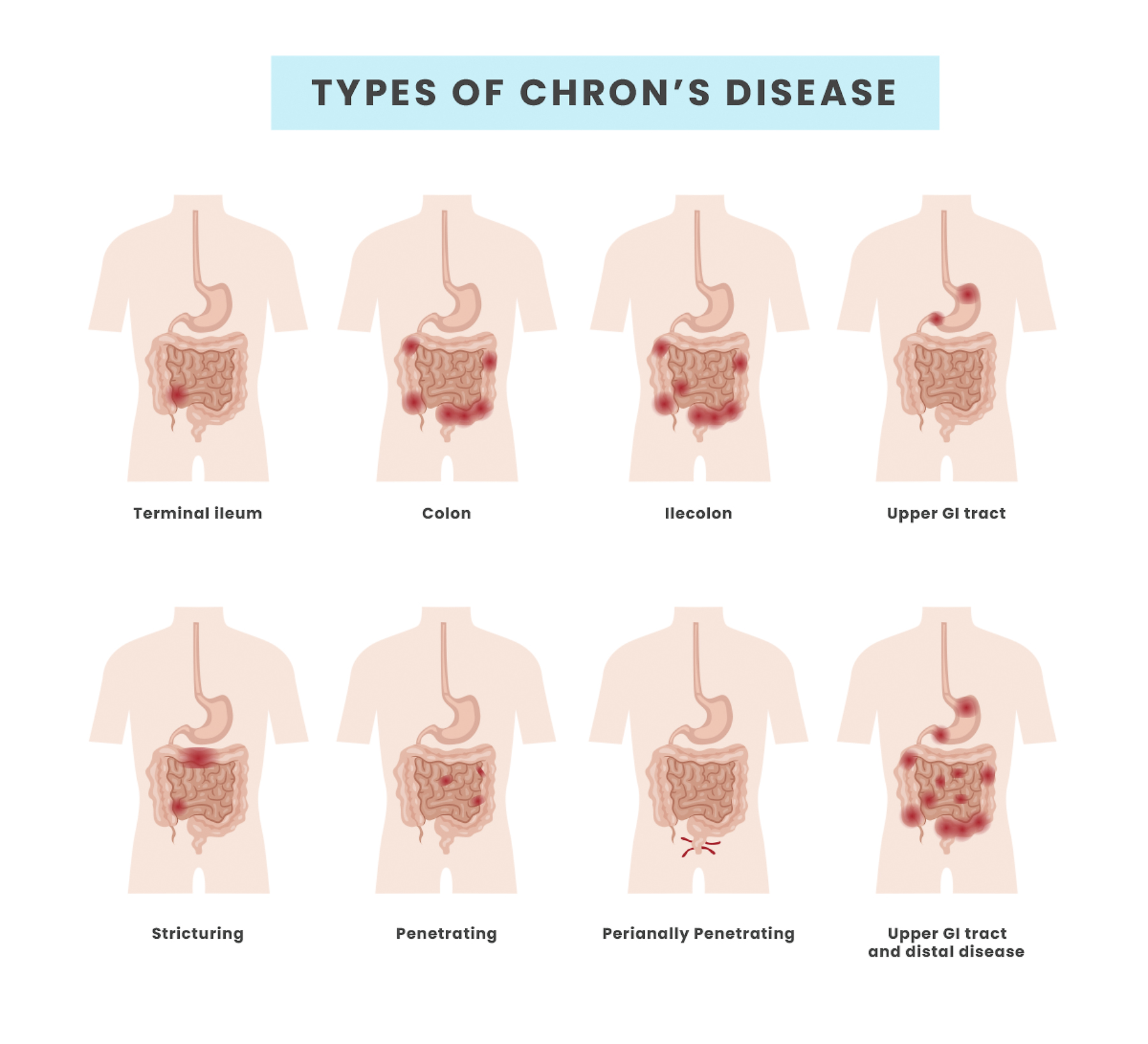 chrons disease types