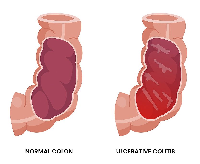Mr Shiyam Nizar, London Bowel Doctor, treatment of Ulcerative Colitis at Frimley, Surrey, London