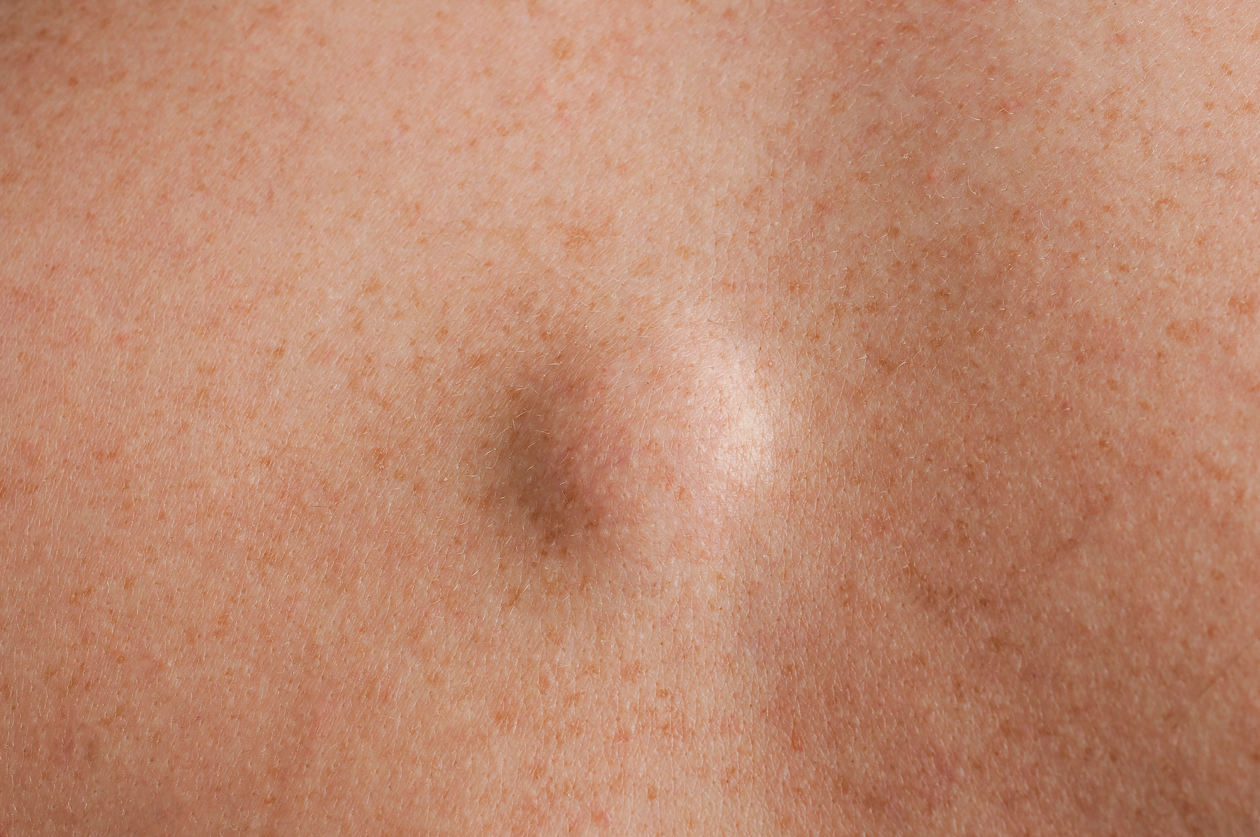 Lipomas & Skin Lesions treatment by Mr Nizar, The London Bowel Doctor