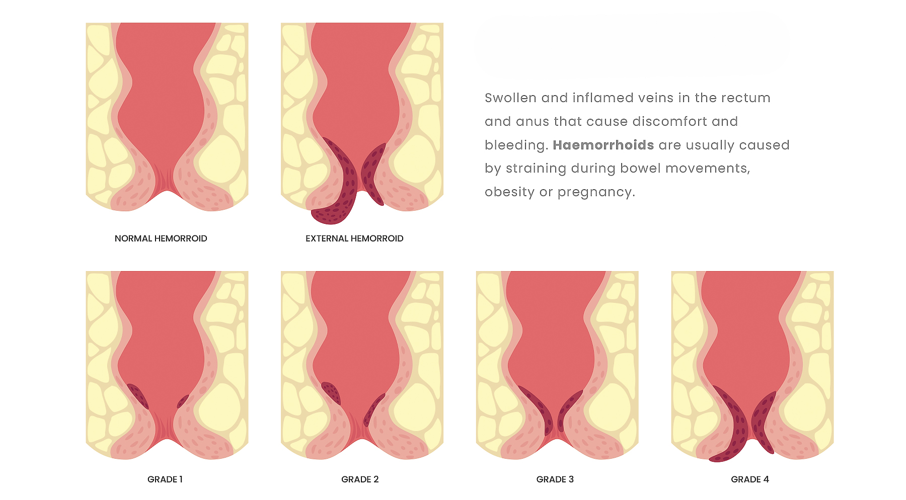 Mr Shiyam Nizar, London Bowel Doctor, diagnosis & treatment of haemorroids at Frimley, Surrey, London